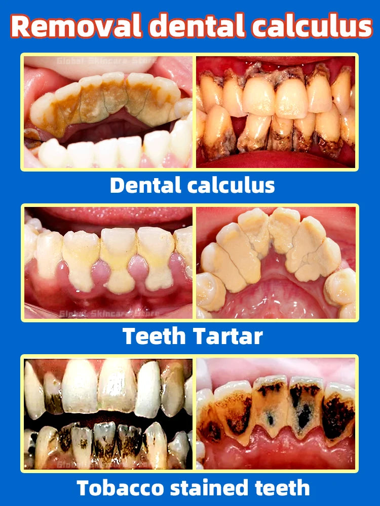 Tartar removers dissolve tartar and remove stains